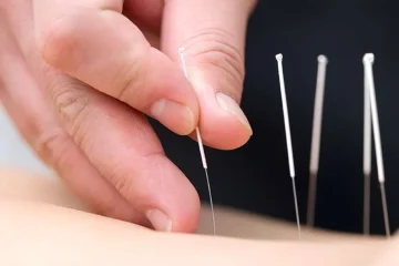 Dry Needling